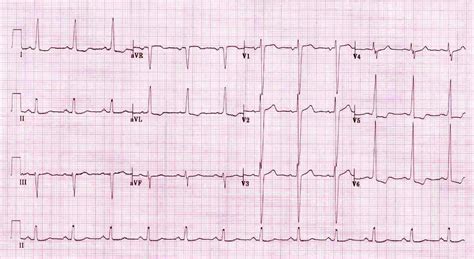 left ventricular hypertrophy life in the fast lane